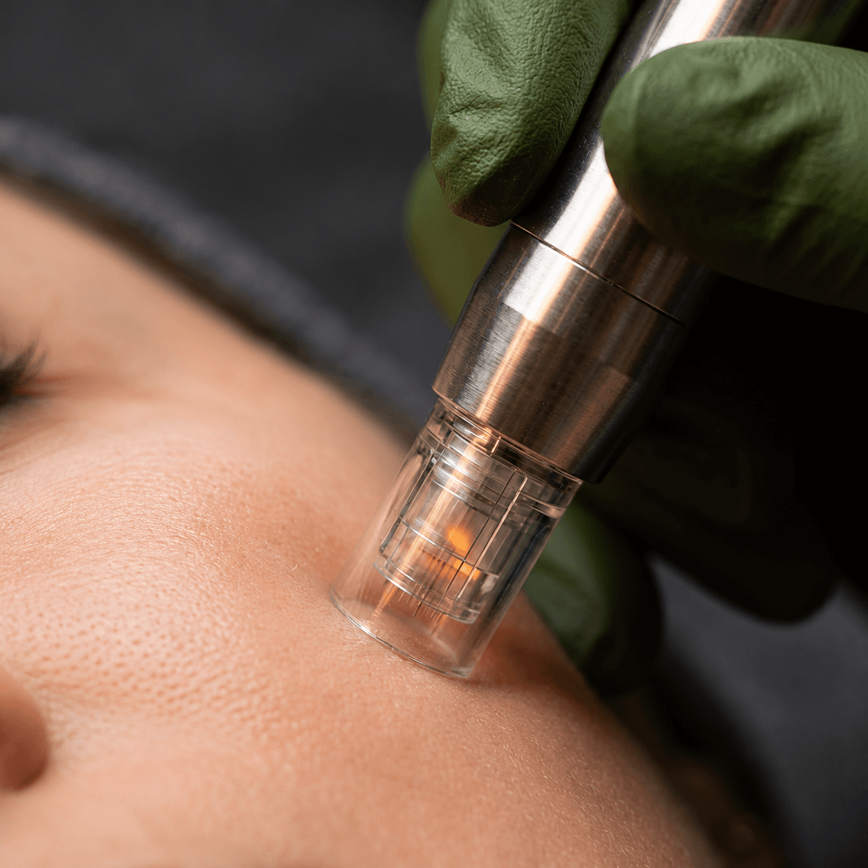 ¡Recupera la salud de tu piel! Paga RD$1,699 en vez de RD$4,500 por un tratamiento de Dermapen a domicilio en Velarosa Spa y Stetic Center — imagen 1