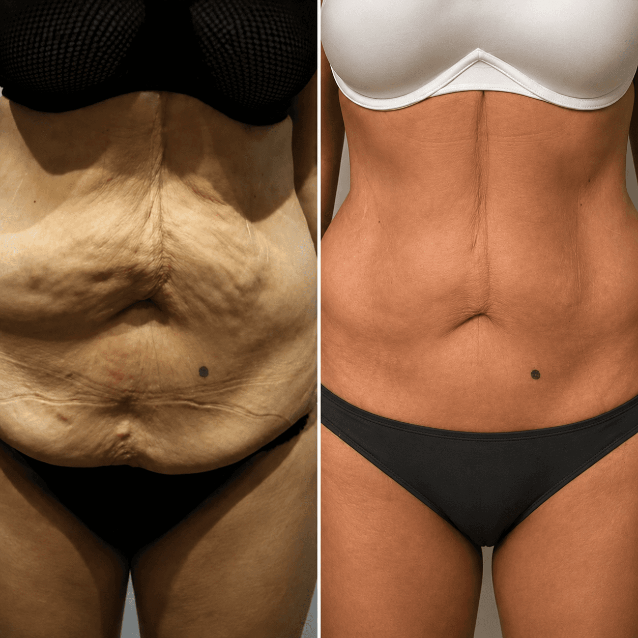 ¡Reafirma y tonifica tu abdomen! Paga RD$2,499 en vez de RD$9,000 por paquete antiflacidez en Yuneiris Glam Stetic