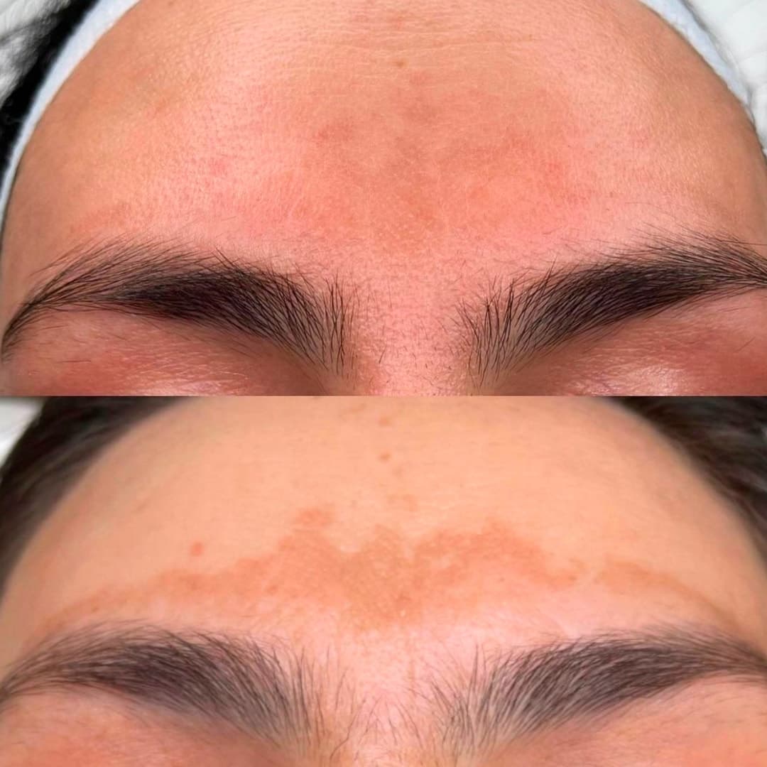 ¡Luce un rostro con tono más uniforme! Paga RD$1,999 en vez de RD$5,000 por Tratamiento Láser para Manchas de Melasma en Yuneiris Glam Stetic